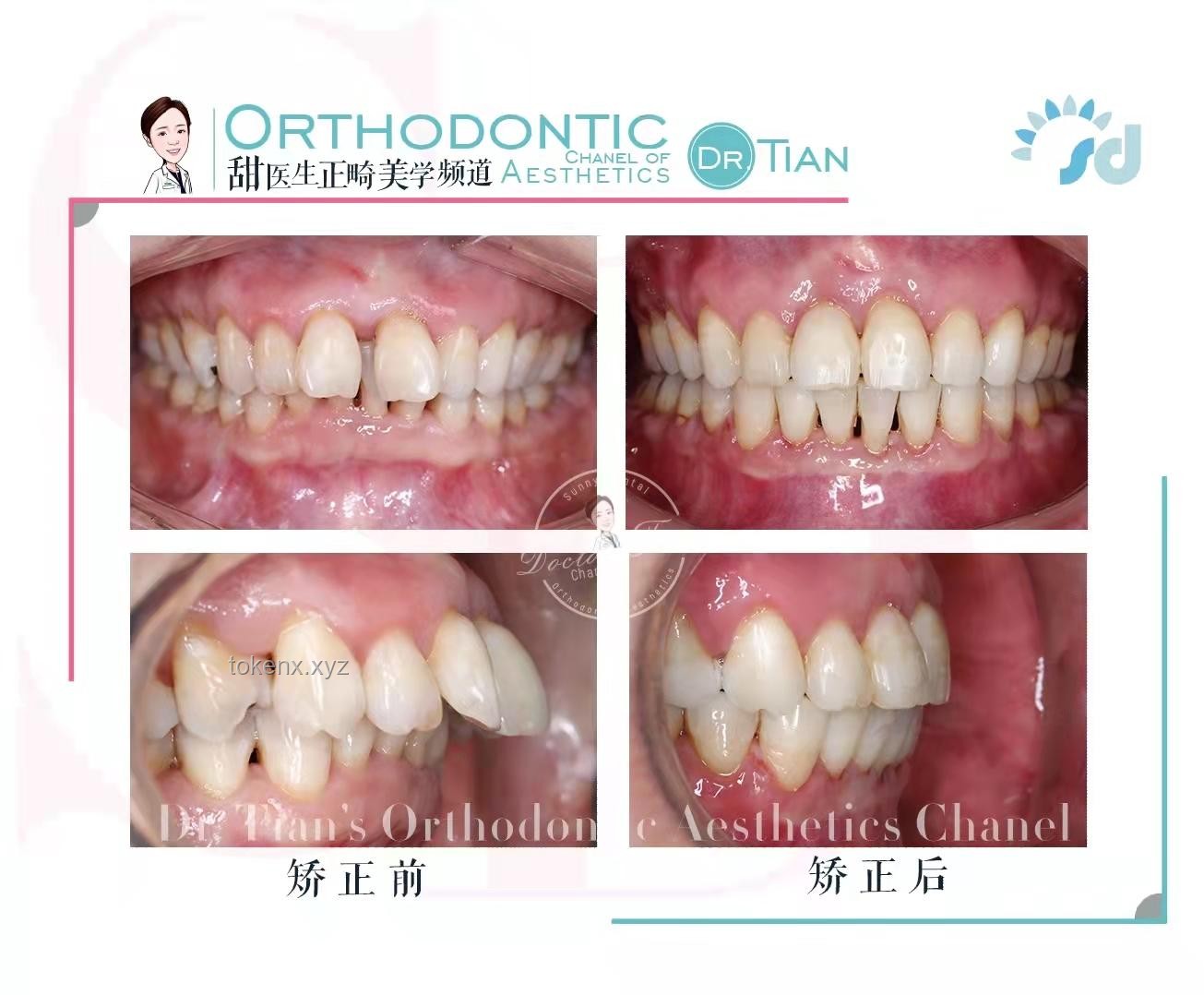 韦东奕牙周炎治疗案例研究：多次治疗与健康管理